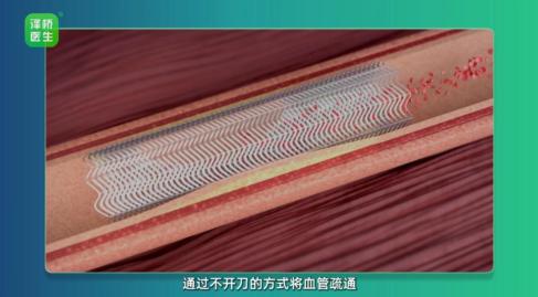 700块的心脏支架你敢用吗?救命稻草还是过时技术?