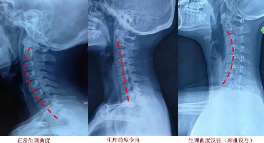 颈椎侧位片怎么看图片