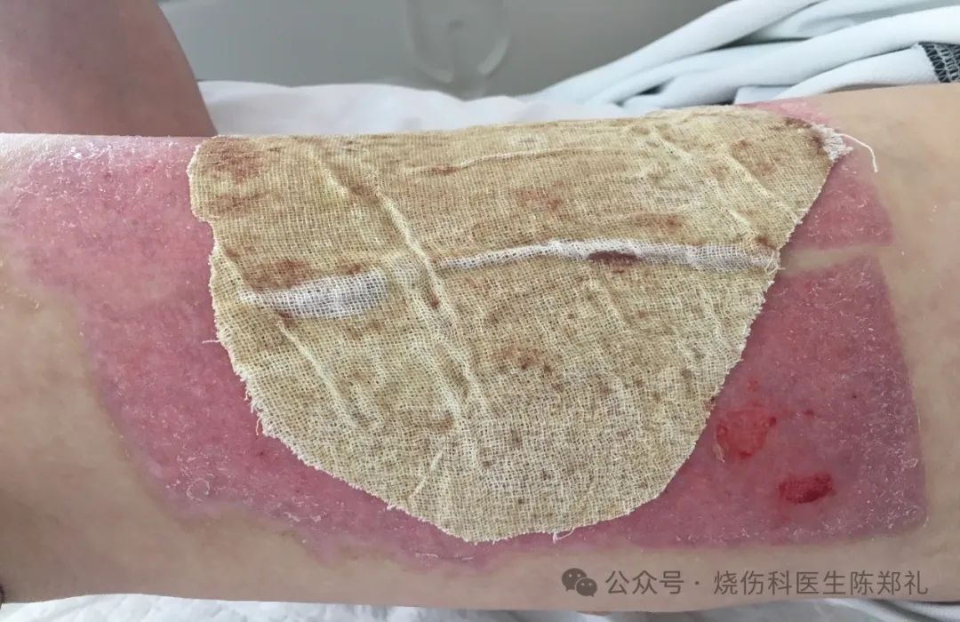 使用油性药膏算不算湿性愈合?_澎湃号·湃客_澎湃新闻-the paper