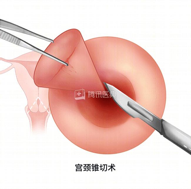 和所有的手术一样,宫颈锥切术也有发生术后并发症的风险