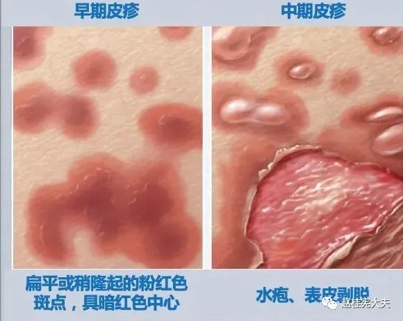 致命性药疹——卡马西平和sjs/ten的恩怨纠葛