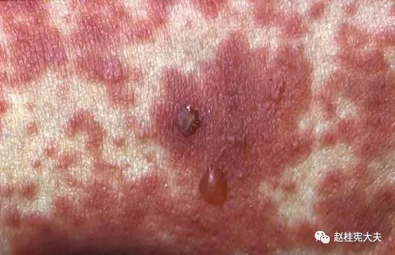 致命性药疹——卡马西平和sjs/ten的恩怨纠葛