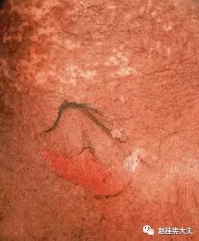 致命性药疹——卡马西平和sjs/ten的恩怨纠葛