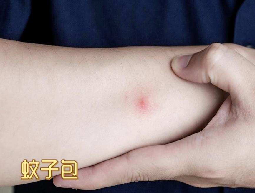 越挠越痒,越挠越多可能荨麻疹在作祟