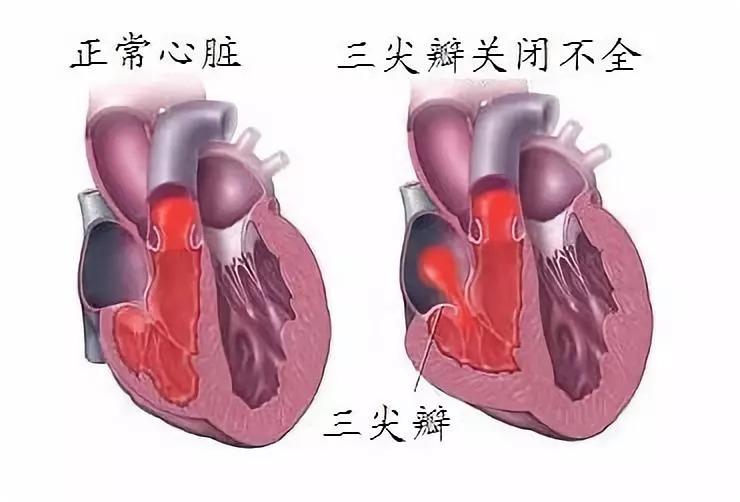的原因是其心脏又出现了三尖瓣大量返流的情况，严重增加了心脏的负担。