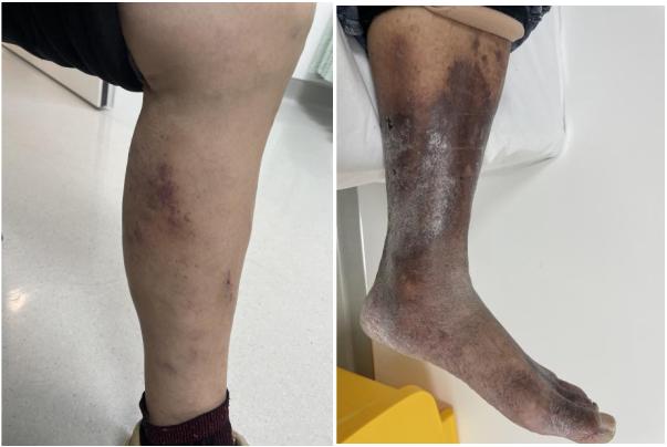 下肢静脉曲张治疗