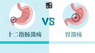 一圖讀懂丨十二指腸潰瘍 VS 胃潰瘍