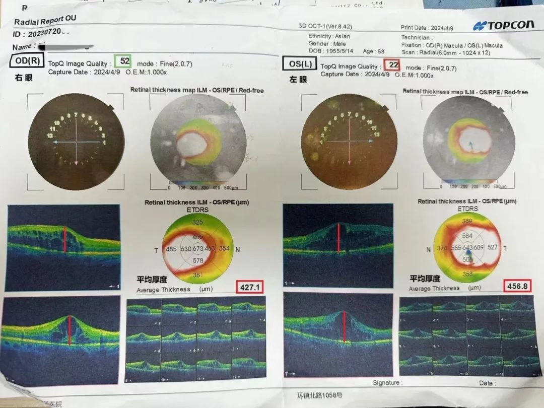 打针前患者双眼黄斑oct检查报告图1打针后患者双眼黄斑oct检查报告图2