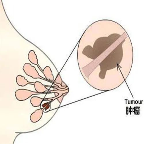 0cm肿物,乳腺纤维腺瘤或者叶状肿瘤可能",随即女孩被收