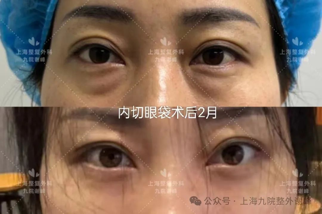 内切眼袋眶隔释放术