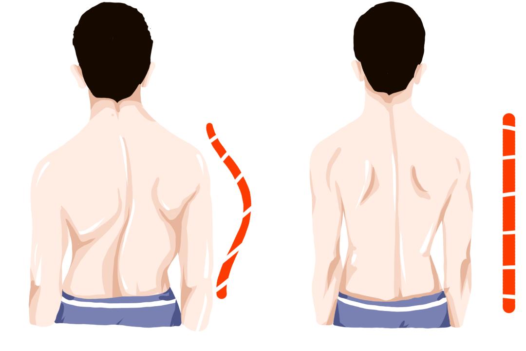 脊柱侧弯与青少年儿童近视,斜视会相互影响吗?