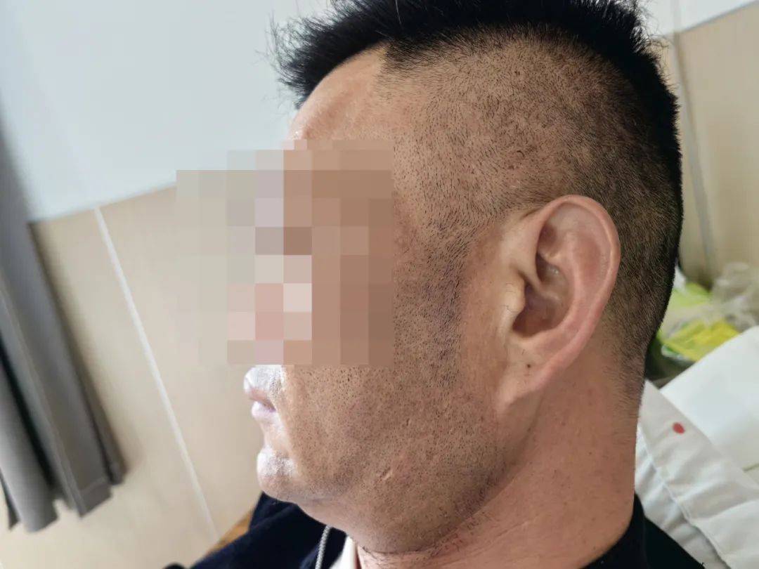 揭秘肢端肥大症:高血糖背后的罕见内分泌疾病丨贤医健康说