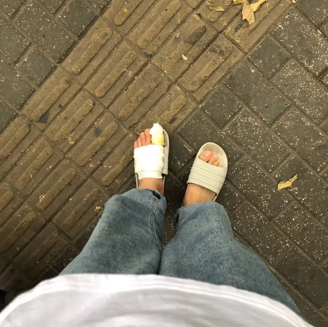 拔了几根汗毛,我的脚肿成了"大猪蹄子"