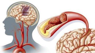 血脂究竟对脑部健康有什么影响？
