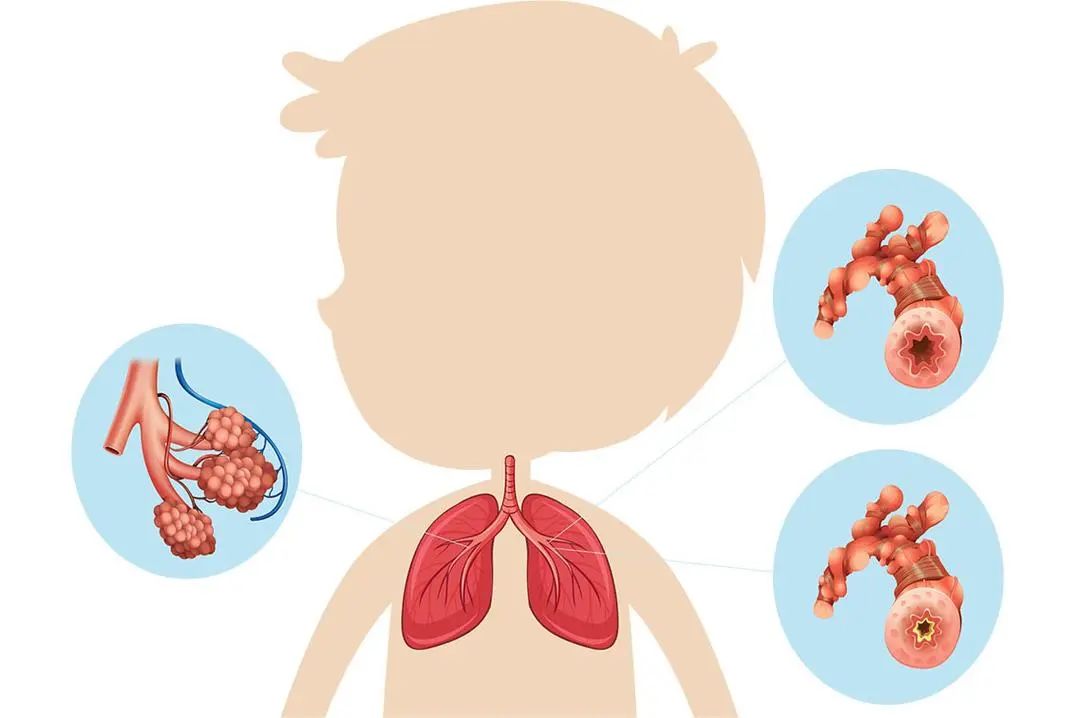 小儿肺炎卡通图片图片
