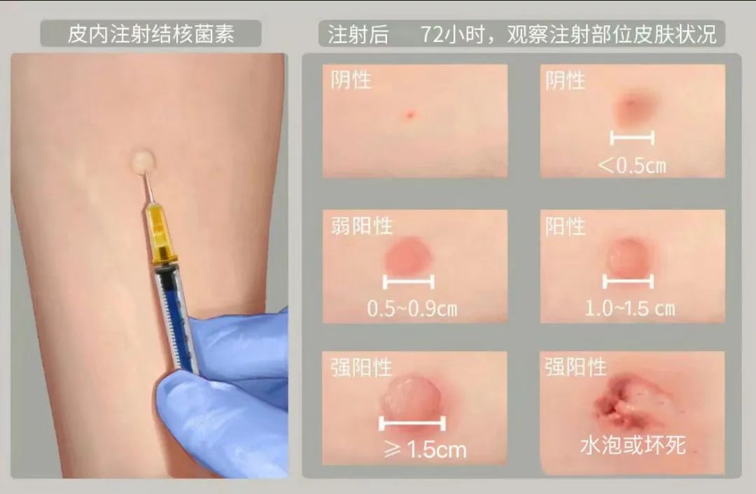 ppd阴性正常图 对比图片