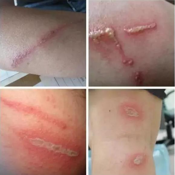 小小虫子,不得不防