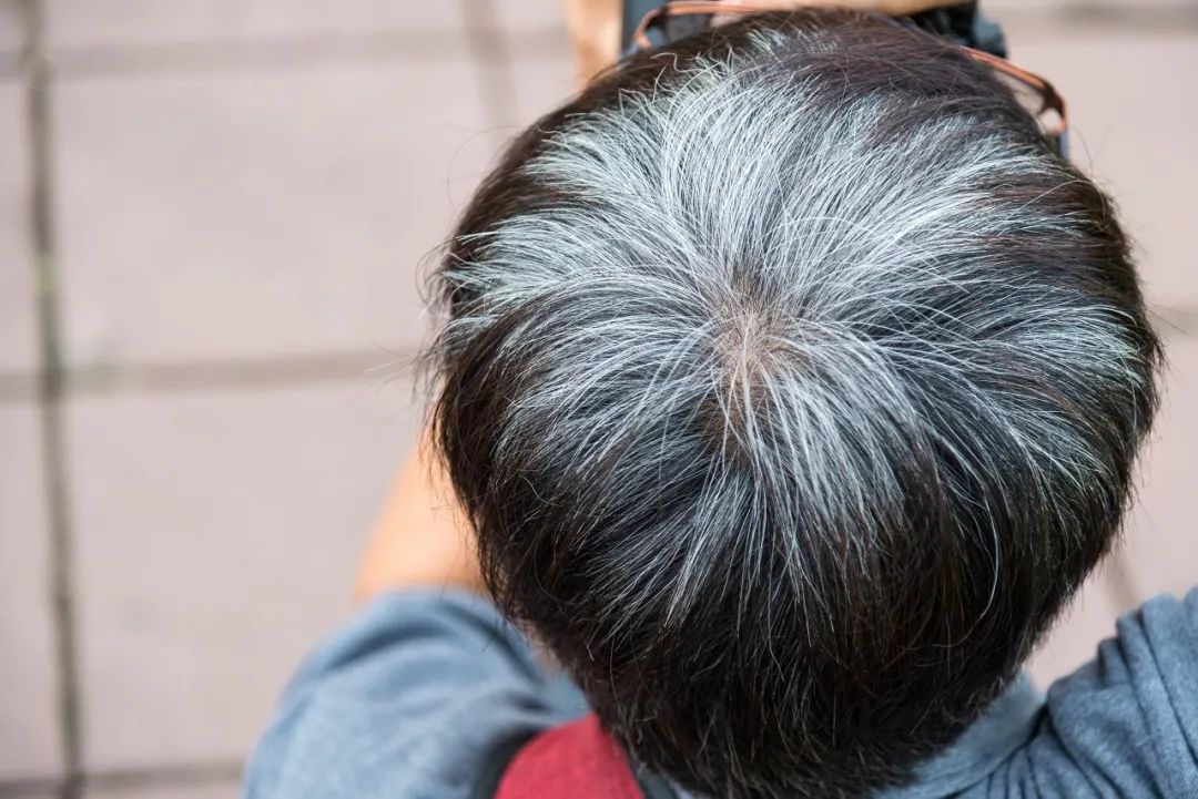 图片,转载使用可能引发版权纠纷那么,怎么判断自己是不是病态的白发呢