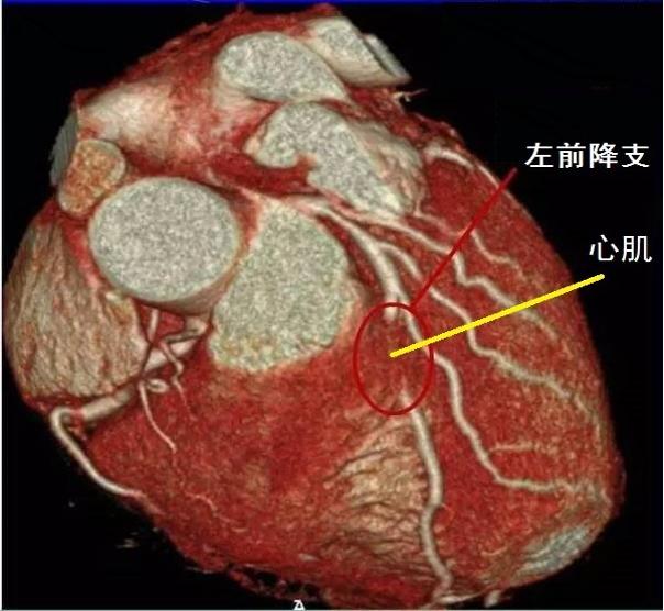 也就是说冠状动脉被心肌组织覆盖,当有一段冠状动脉穿行于心肌内,左前