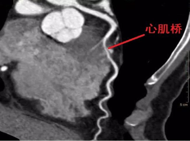 什么是心肌桥?会不会有危险?该怎么治疗?