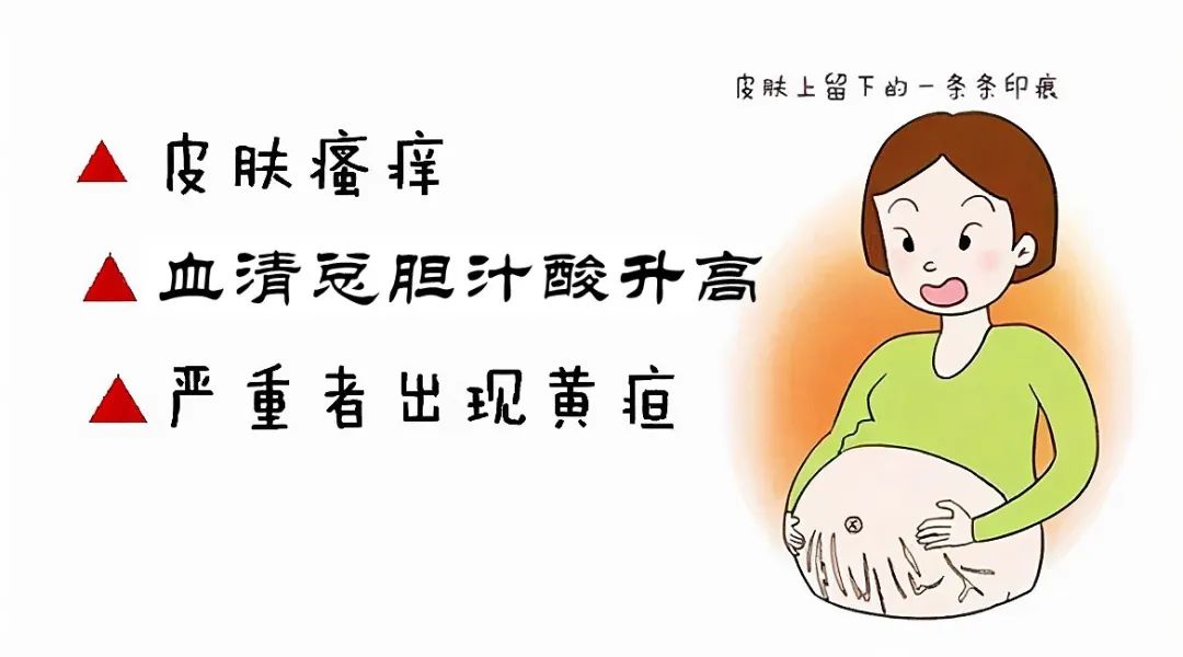 妊娠期肝内胆汁淤积症:孕期的隐形威胁