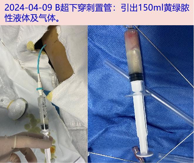 腰大肌脓肿(大小75mm×65mm),右侧臀部脓肿(大小62mm×25mm)穿刺置管
