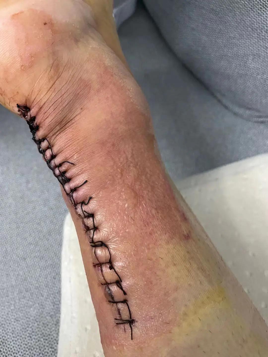 附属第十人民医院骨科副主任医师跟腱是人体小腿后下方最强大的肌腱