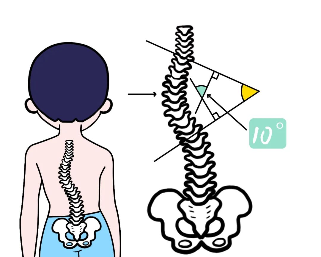 儿童节健康科普——青少年脊柱侧弯