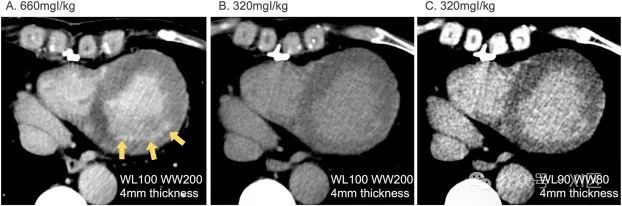 如何获得高质量心脏ct延迟强化图像?