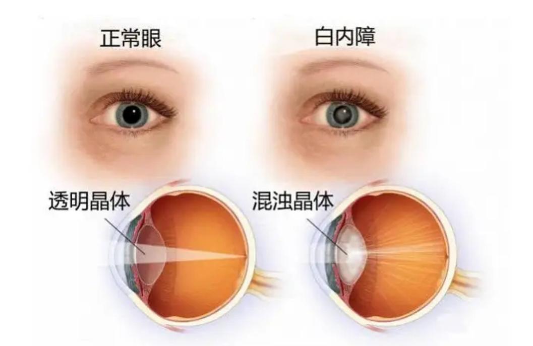 百姓健康 | 怎样防治糖尿病性眼病?