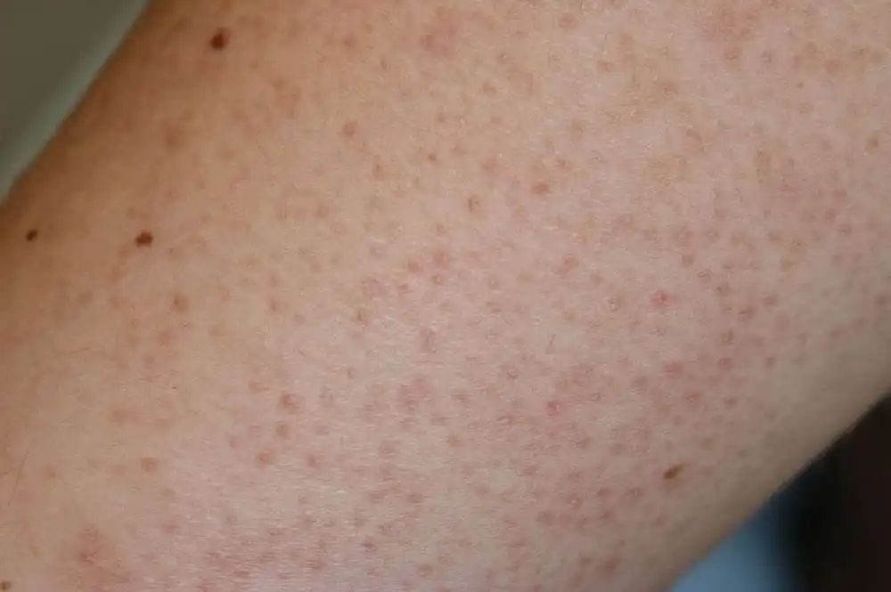 毛周角化病(keratosis pilaris, kp)」,是一种常见的慢性毛囊性皮肤病