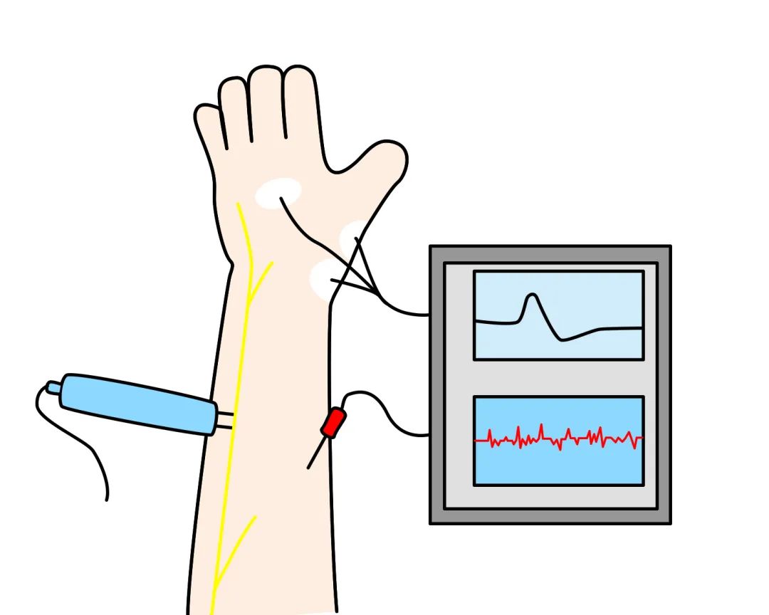 肌电图注意事项图片