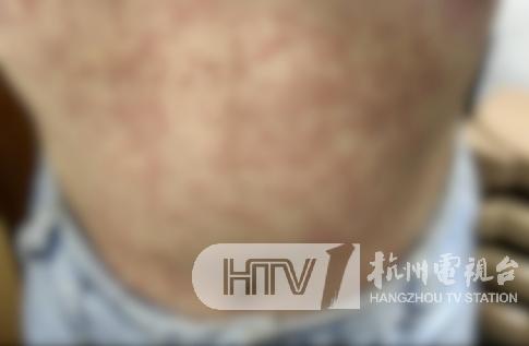 五月不减肥，六月徒伤悲？当心减肥引发皮肤病，全身红疹瘙痒难眠