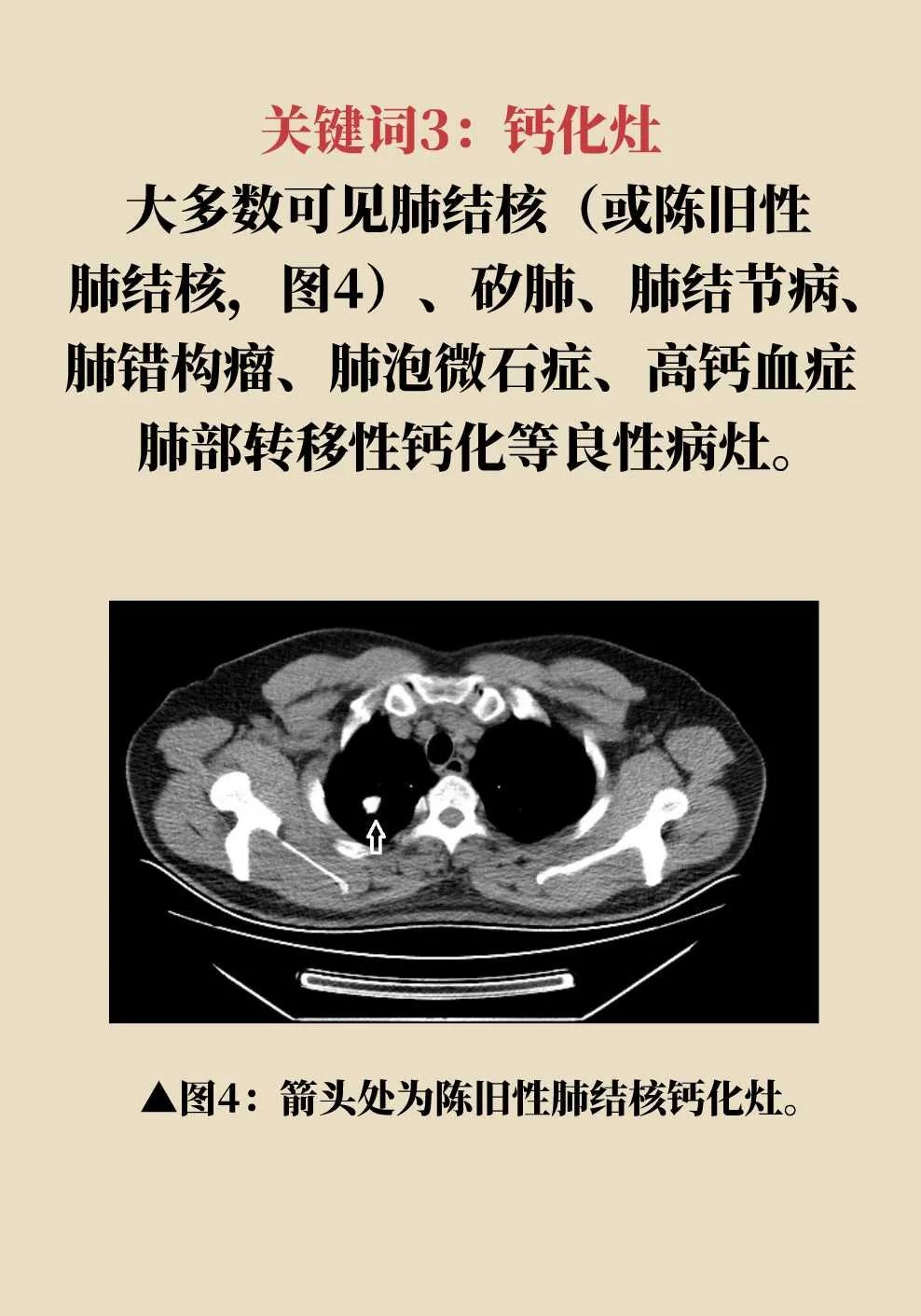 解密肺部ct报告的14个关键词