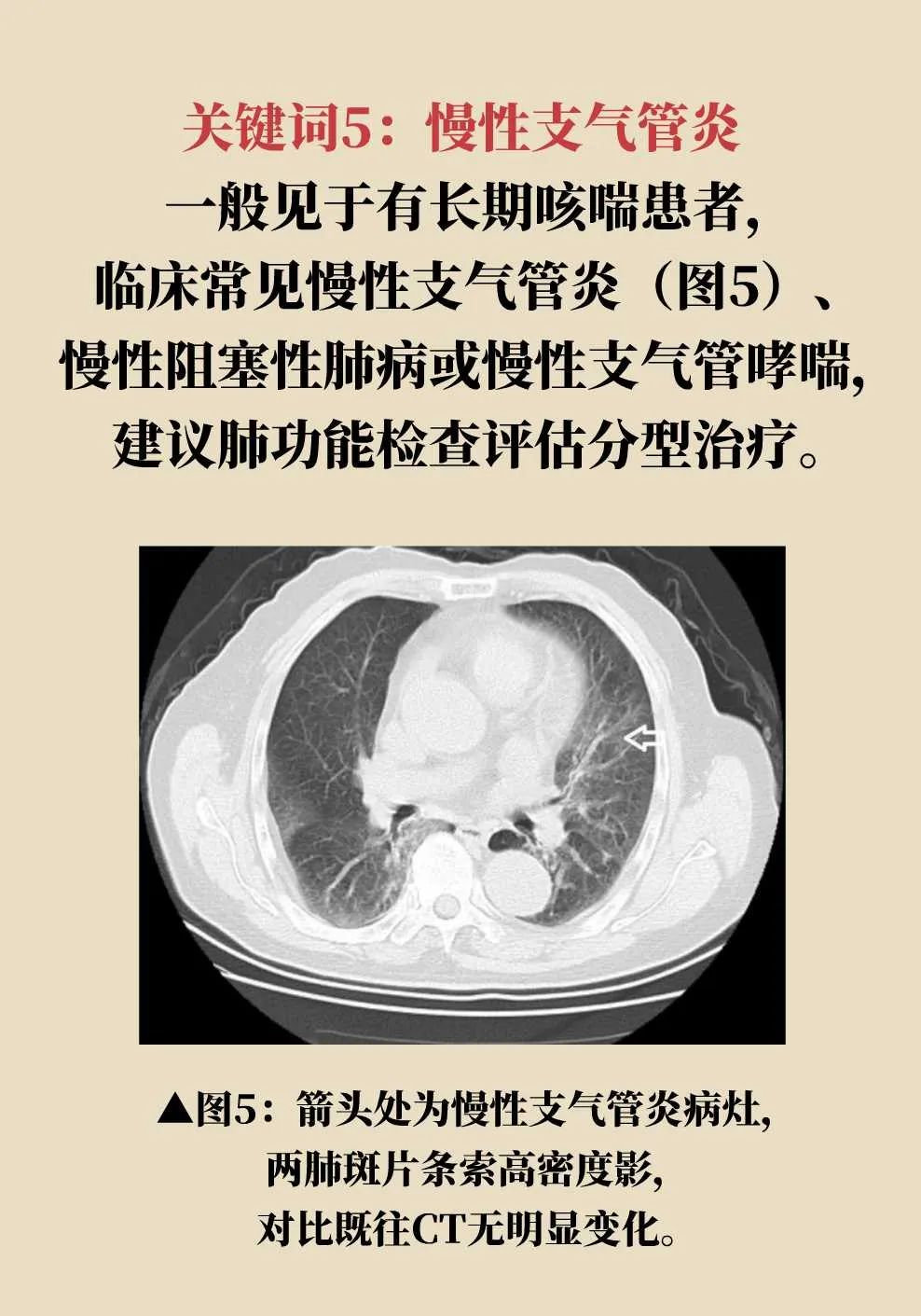 解密肺部ct报告的14个关键词