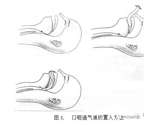 气管插管及紧急气道管理,"急诊干货"值得收藏