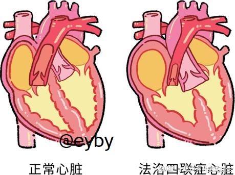 两次开心三获冬奥冠金——法洛四联症与单板之王