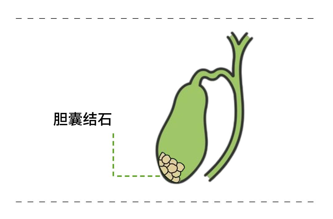 女子体内取出24颗石头!这5类人容易被胆结石缠上