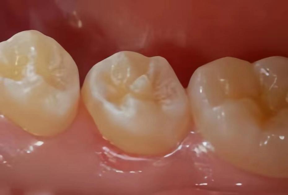 于下颌牙自中线向两侧数起的第四,第五颗牙齿,也就是第一,第二前磨牙