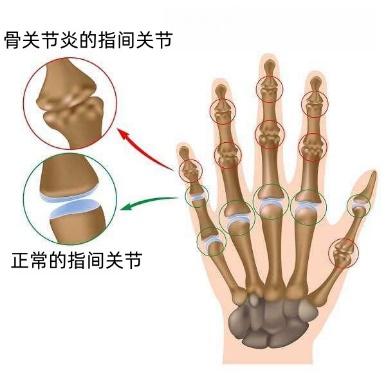 勿把骨关节炎当成类风湿!