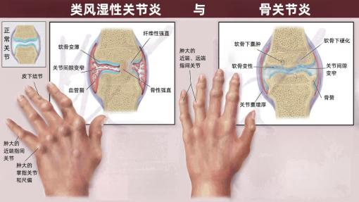 大多角骨疼图片