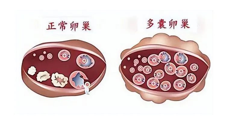 科普 得了多囊卵巢综合症怎么办?松江医生提醒