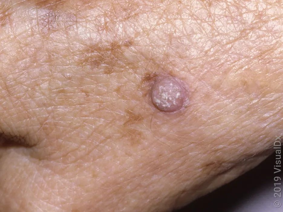 皮肤瘤子图片图片