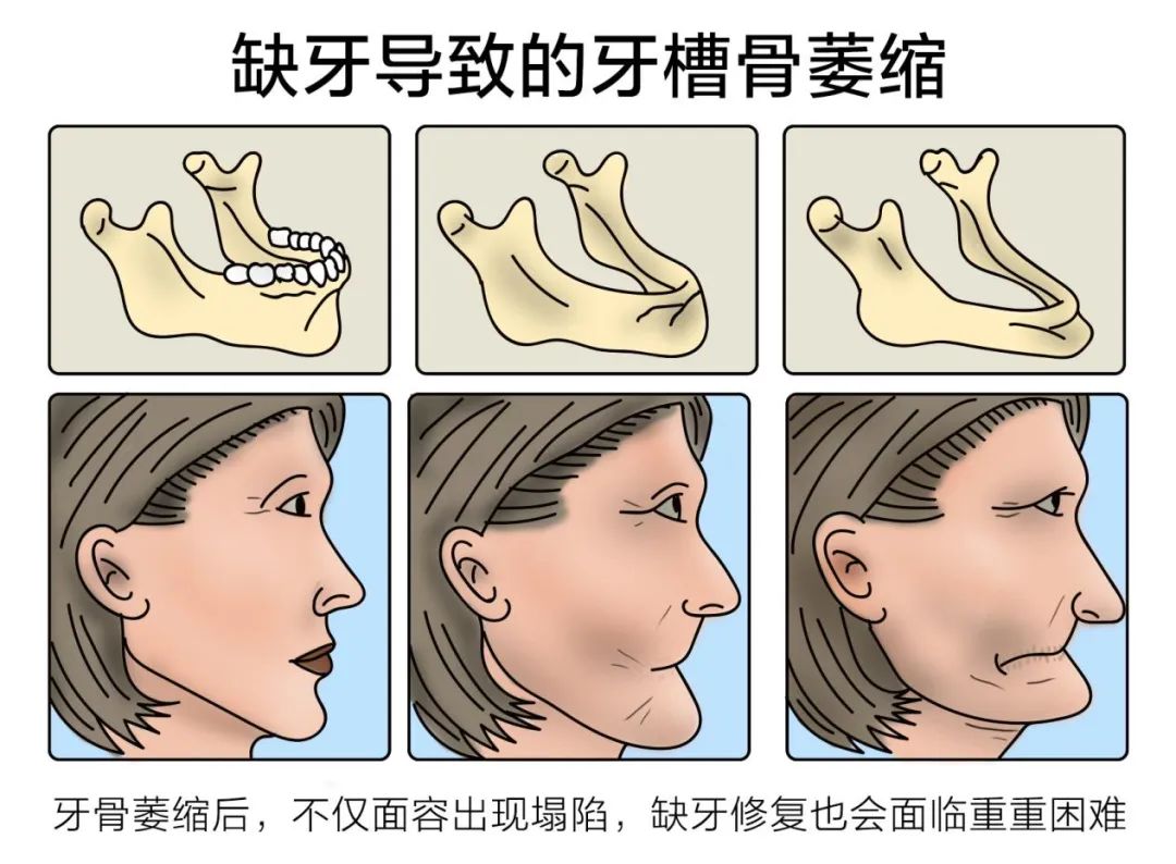 都说缺牙危害大,其实大部分的"老掉牙"都是牙周炎引起的.