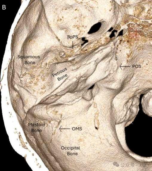 ah:对耳轮,dt:耳轮结节,eam:外耳道,cb:耳轮脚,h:耳轮,icah:对耳轮下