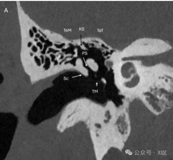 听小骨ct解剖图图片
