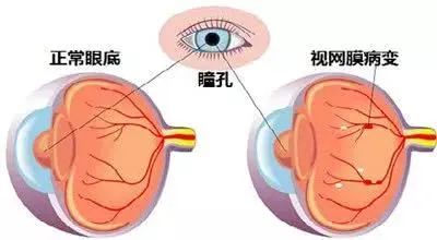 你知道糖尿病视网膜病变吗?松江医生来科普丨健康智慧屋