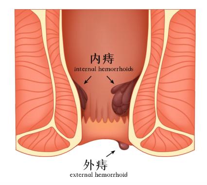 痔疮女性初期图片