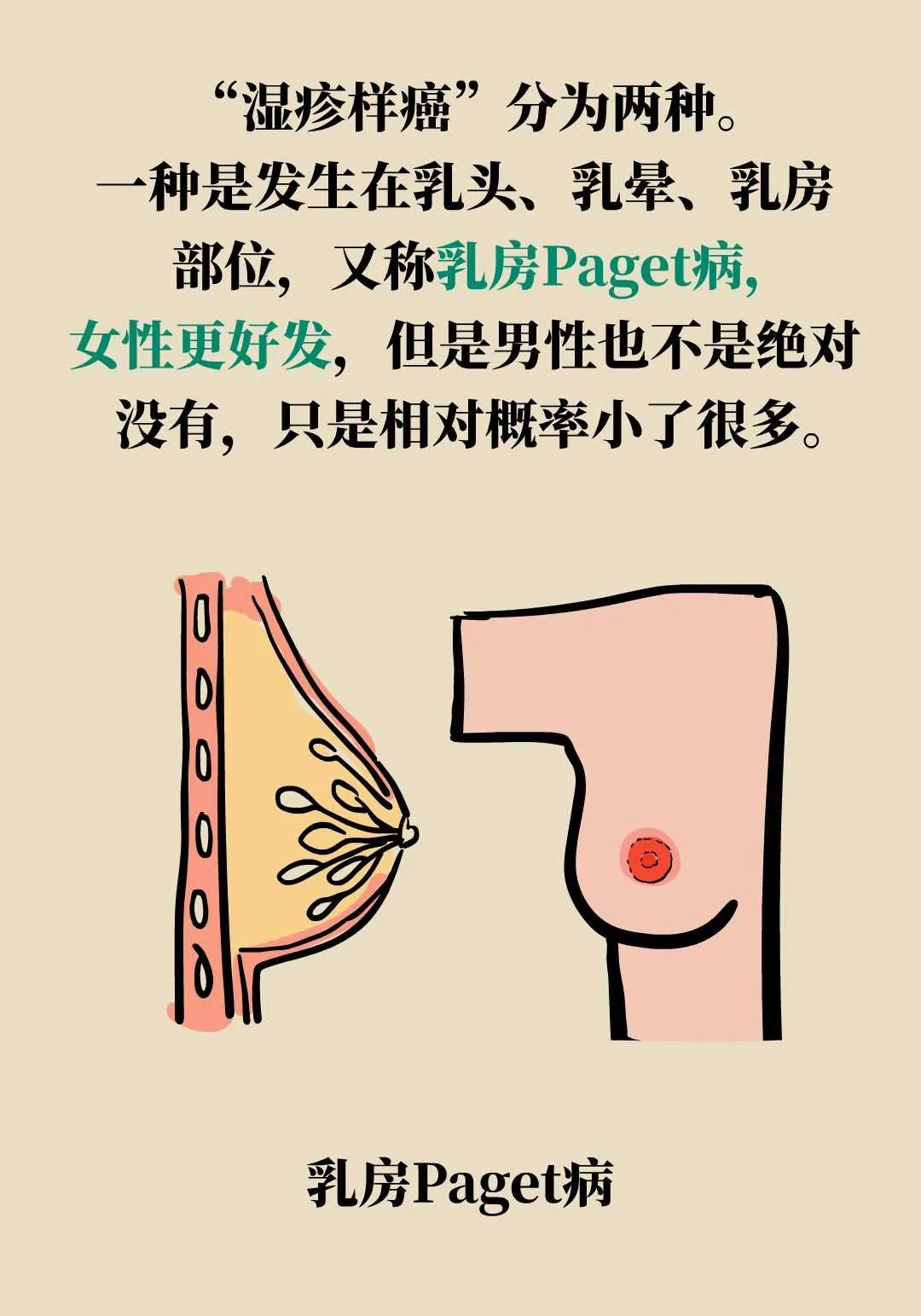 这种"湿疹"竟是癌症?男性尤其要当心
