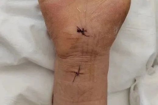 打工人必备,如何拯救你的"鼠标手"